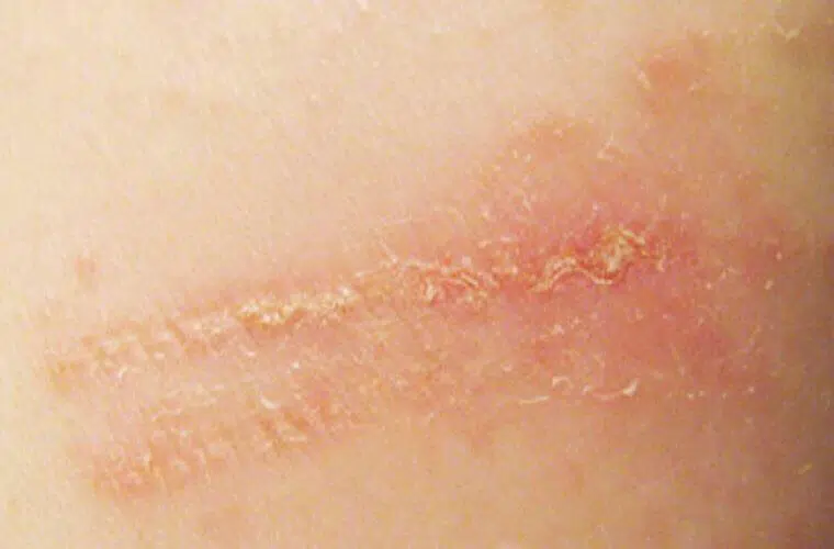 A patch of skin affected by contact dermatitis